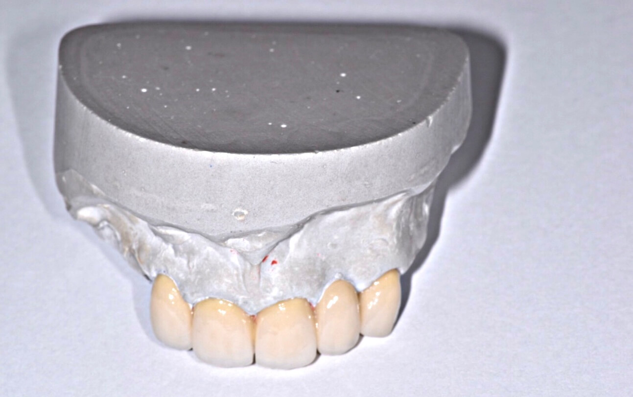 most-metalowy-licowany-porcelaną-niezbędnik-zdrowia-stomatologia-lekarz-dentysta-maja-teresińska